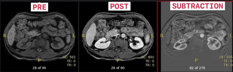 MR Abdomen and Pelvis W/WO BODY Protocol | OHSU